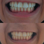 3D WHITE™  - TIRAS BLANQUEADORAS X7 PARES