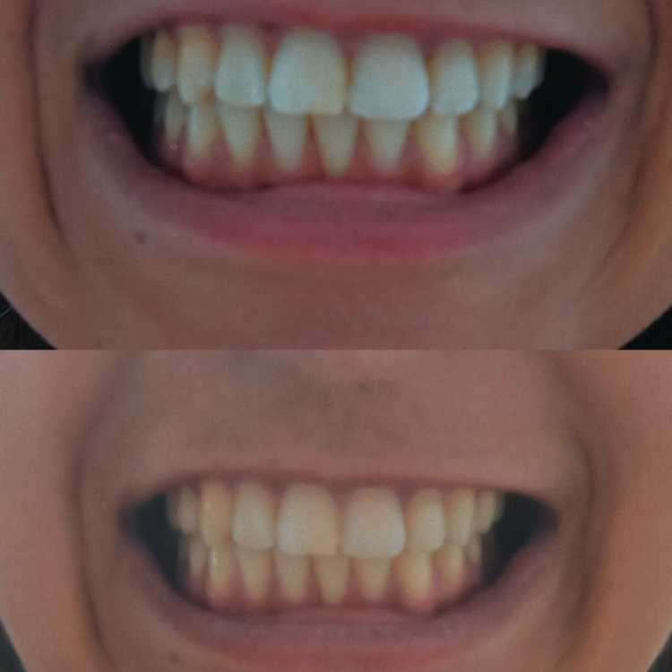 3D WHITE™  - TIRAS BLANQUEADORAS X7 PARES